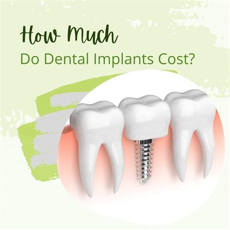 Michigan Dental Implant Costs: 5 Key Things To Know